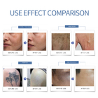 Medical Tattoo Removal Device 1200mj Power Skin Rejuvenation High Efficiency